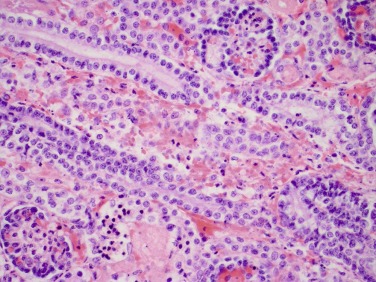 herpeszvírus kórkép